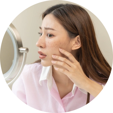 darkspots-blemishes-freckles-acne